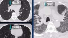 888大奖88pt88:研究：新冠患者肺部伤疤比吸烟严重
